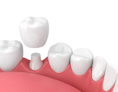 6 Razones por las que podría necesitar una corona dental | Carolina Dental Arts