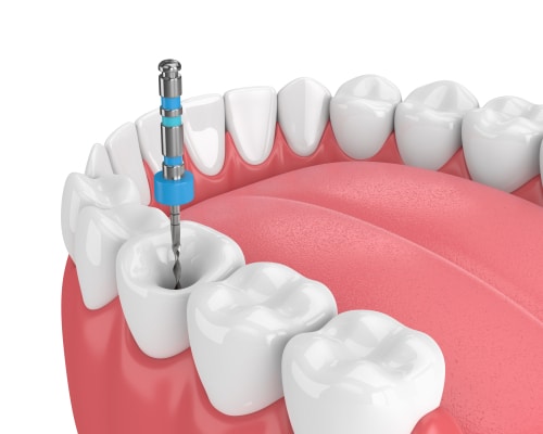 Desmitificando las endodoncias | Carolina Dental Arts | Carolina del Norte