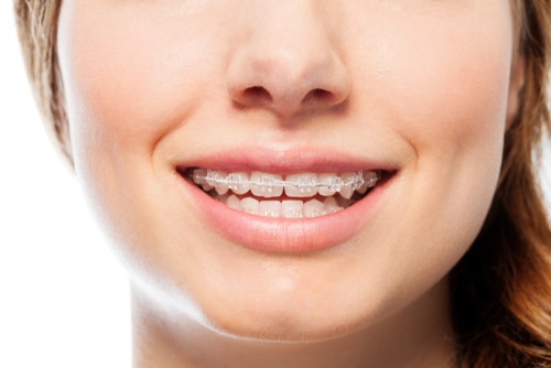 Consiga una sonrisa recta con ortodoncia transparente en sólo seis o nueve meses