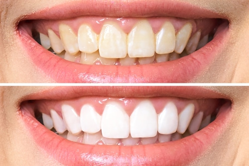 ¿Es el blanqueamiento dental profesional adecuado para mí? | Carolina Dental Arts