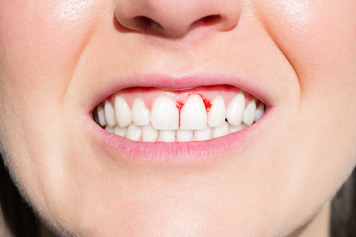 La enfermedad periodontal puede aumentar el riesgo de cáncer