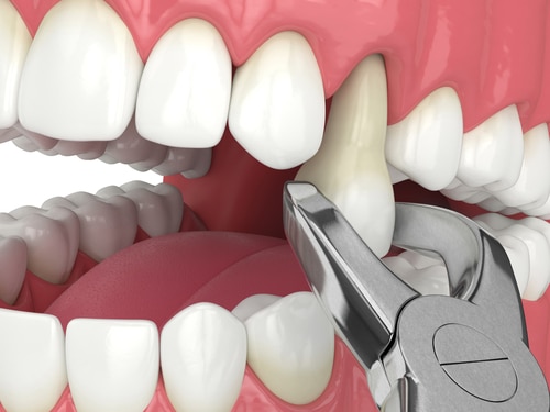 ¿Cuándo se necesita una extracción dental urgente?