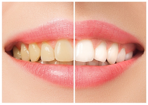 Por qué se amarillean los dientes Carolina Dental Arts Carolina del Norte