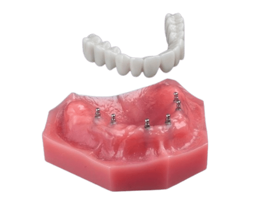 Fix-on-6 en Carolina del Norte | Minidentadura postiza sobre implantes | Opciones de dentadura postiza