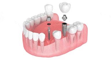Implantes Dentales el Mismo Dia en Carolina del Norte | Mini Implantes Dentales