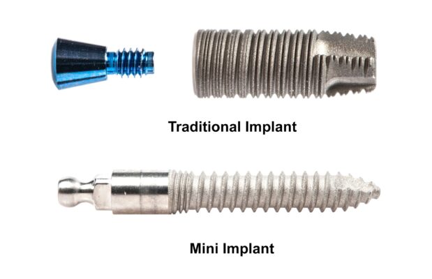 Snap-On Dentures in North Carolina | Full Mouth Dental Implants